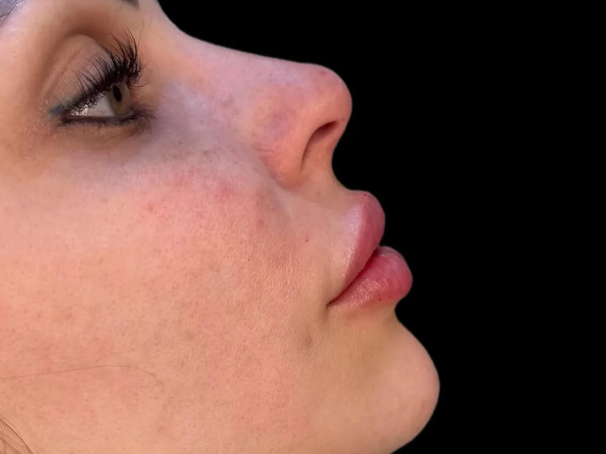 Preenchimento labial — depois